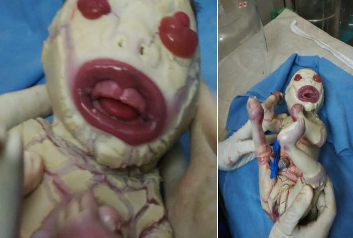 delhi Kasturba Gandhi Hospital weird baby born with Harlequin ichthyosis disorder