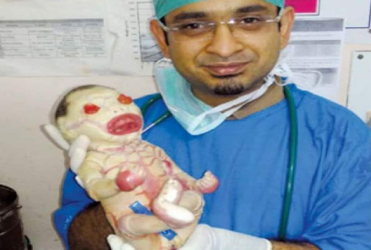 delhi Kasturba Gandhi Hospital weird baby born with Harlequin ichthyosis disorder