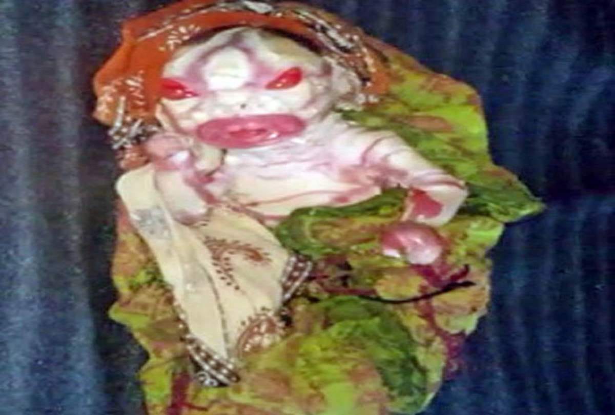 delhi Kasturba Gandhi Hospital weird baby born with Harlequin ichthyosis disorder