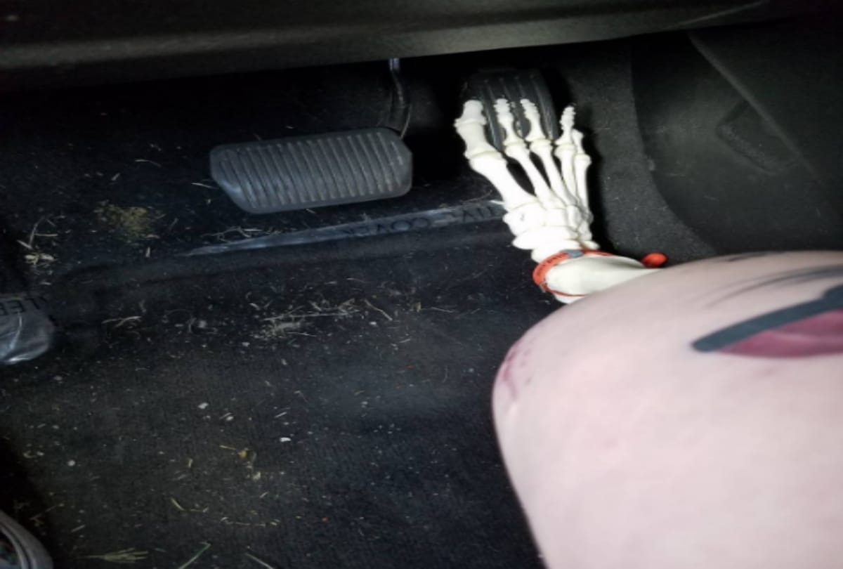 A wonder foot Girl keeps her leg Bone in america