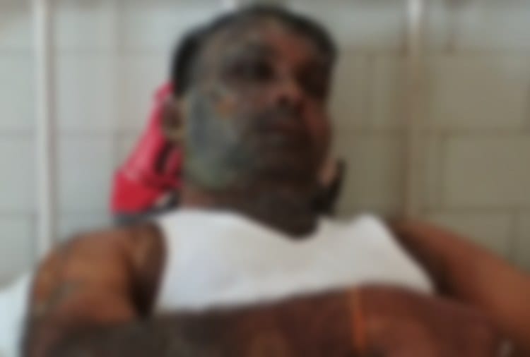 Acid Attack on Man in Firozpur of Punjab