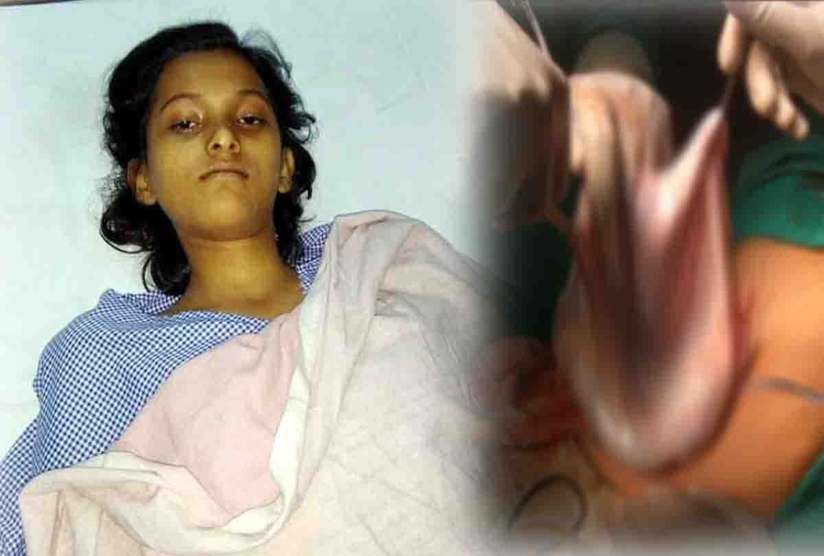 A 20 kg tumor coming out of the teenager stomach