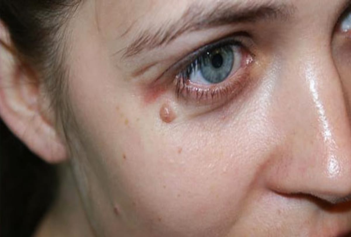 best home remedies to remove warts from face and body