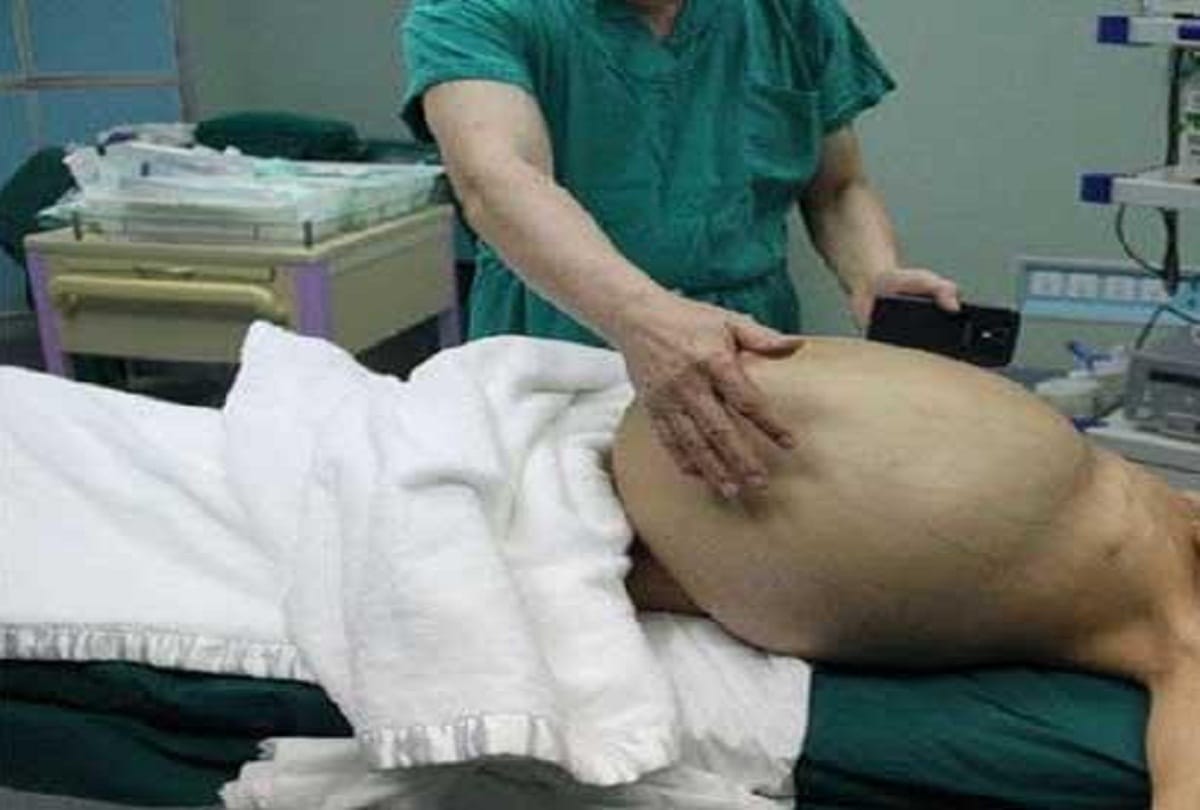 two kg Cancer tumor come out from 4-year-old girl stomach in Delhi