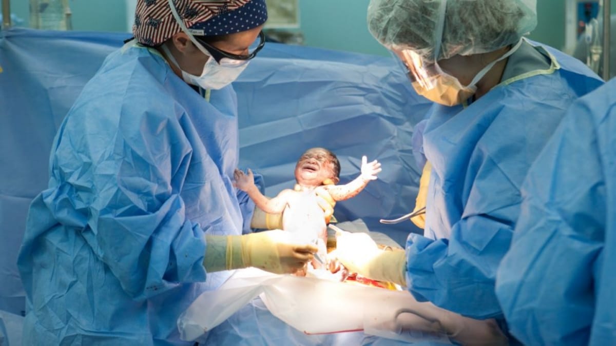 India has double cases of child birth by cesarean, 25% can