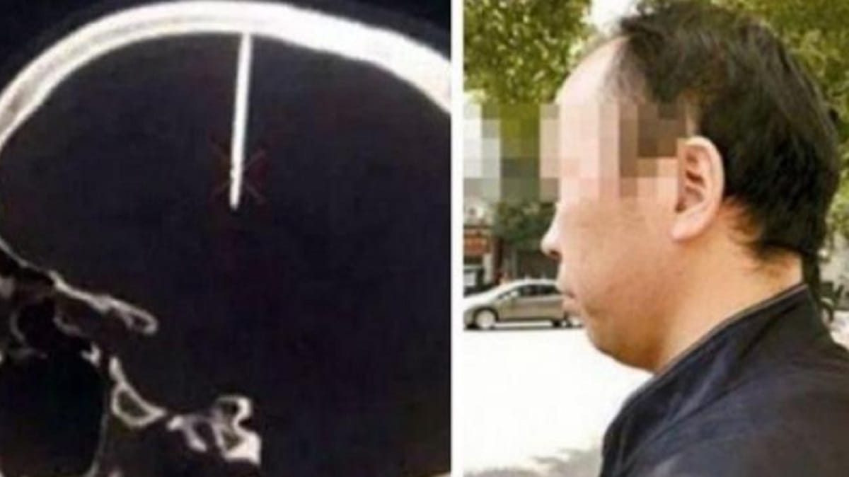 48 mm long nail found inside the brain