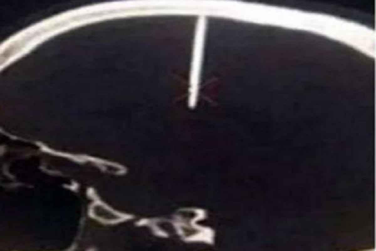 48 mm long nail found inside the brain