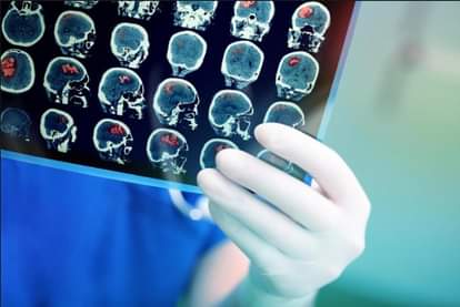 these neurological symptoms are seen in the covid infected