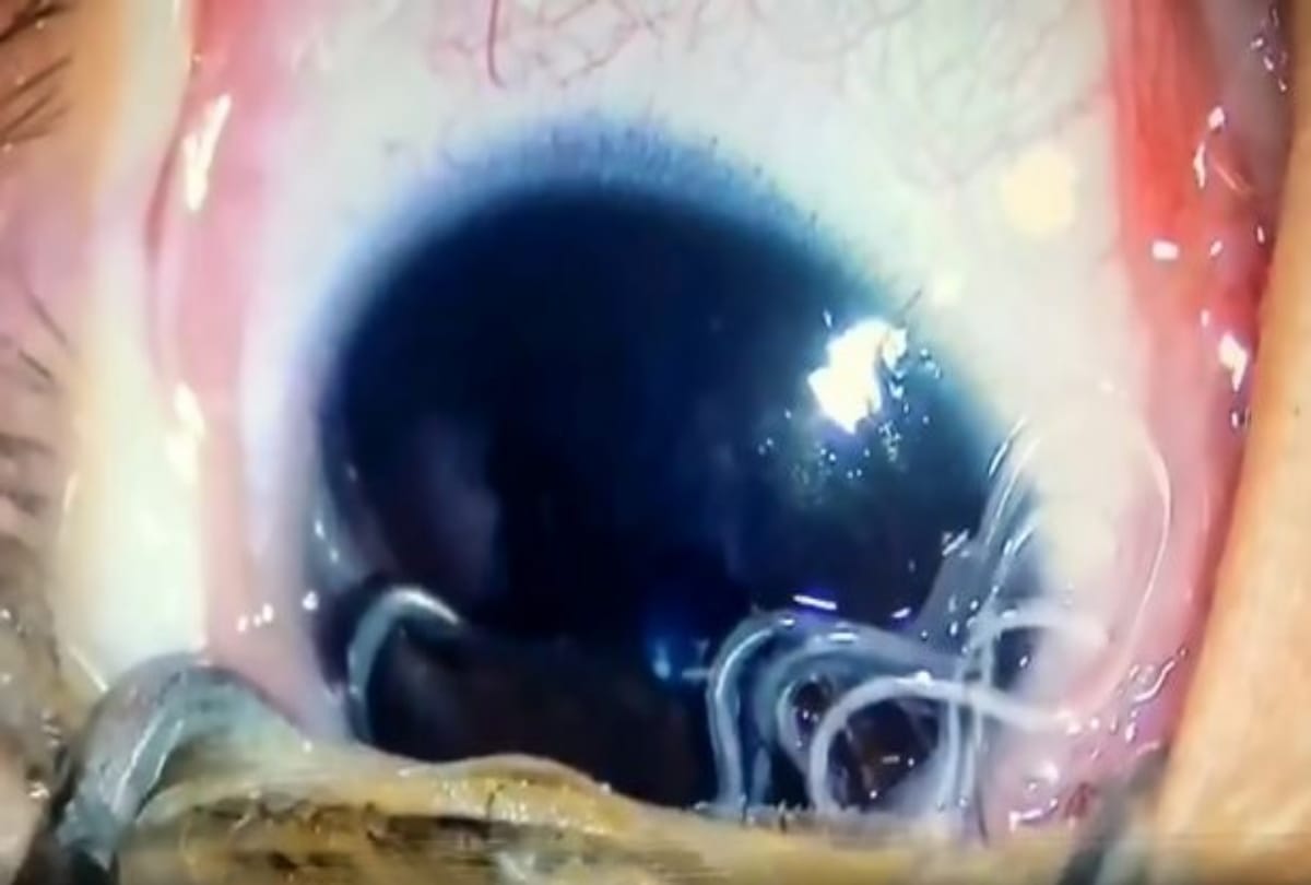Doctors pluck eleven live worms in five month baby Eye