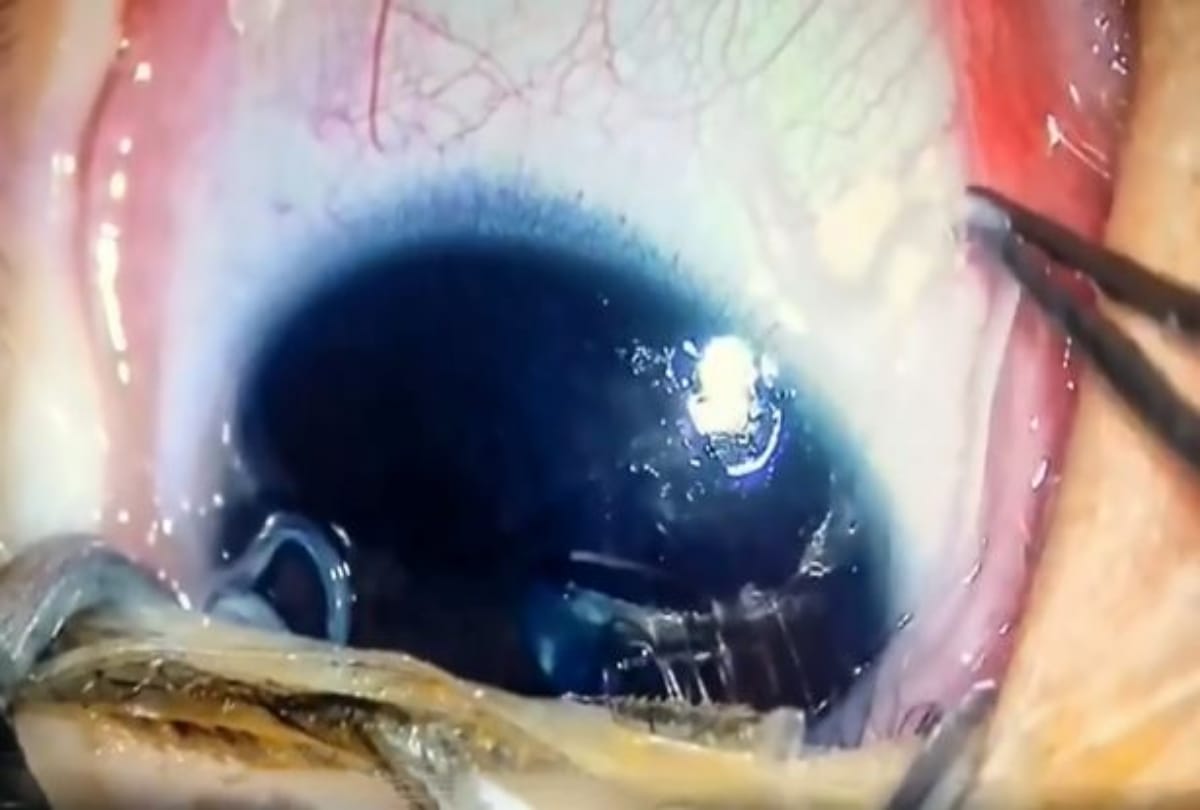 Doctors pluck eleven live worms in five month baby Eye