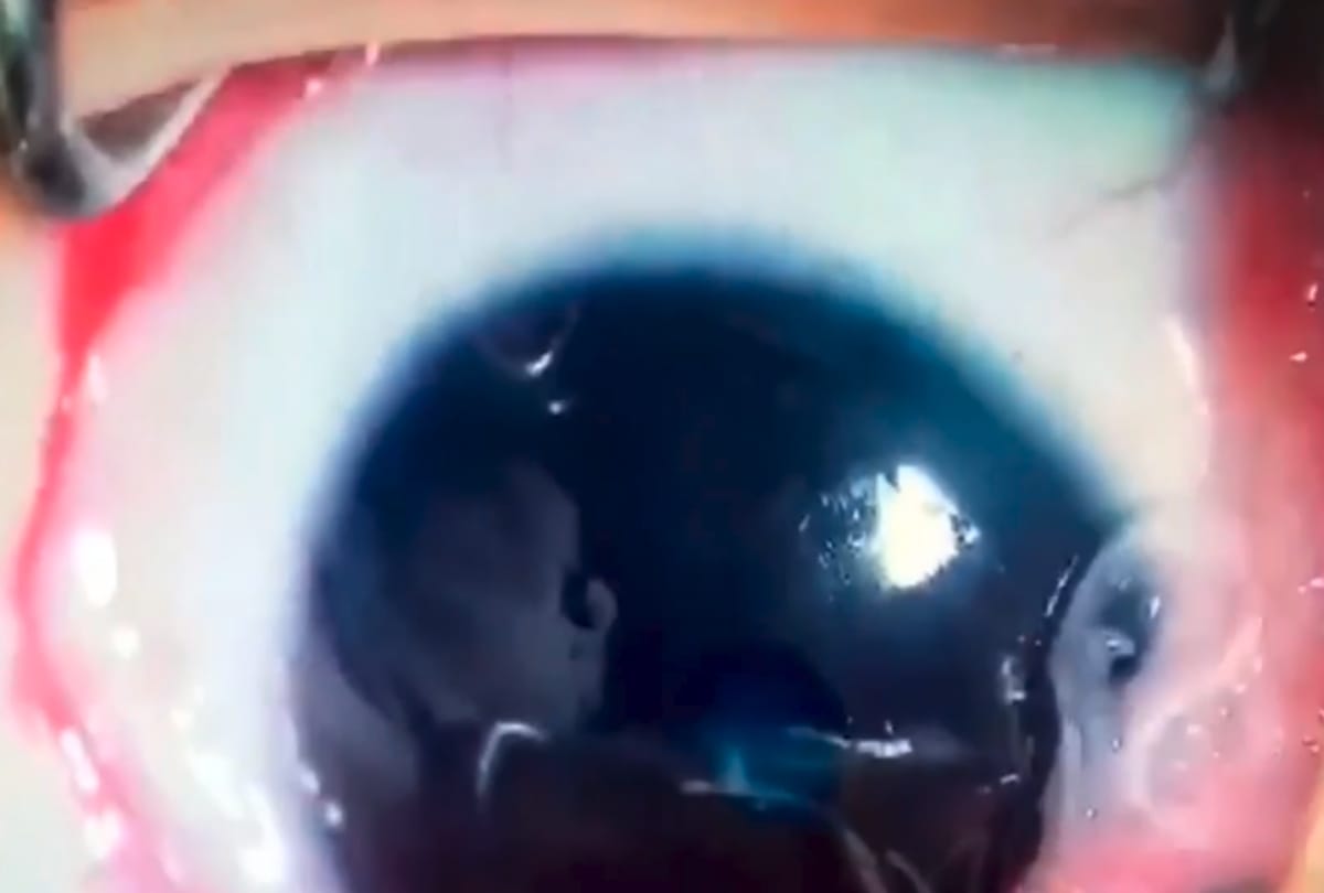 Doctors pluck eleven live worms in five month baby Eye