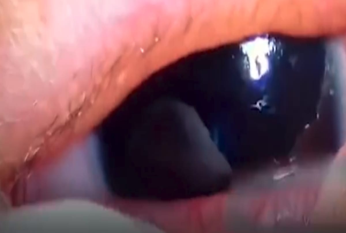 Doctors pluck eleven live worms in five month baby Eye
