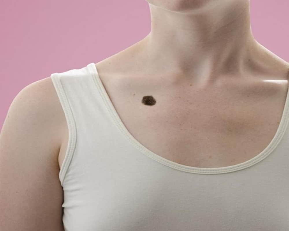 Know how Moles on body that reveal about your relationship