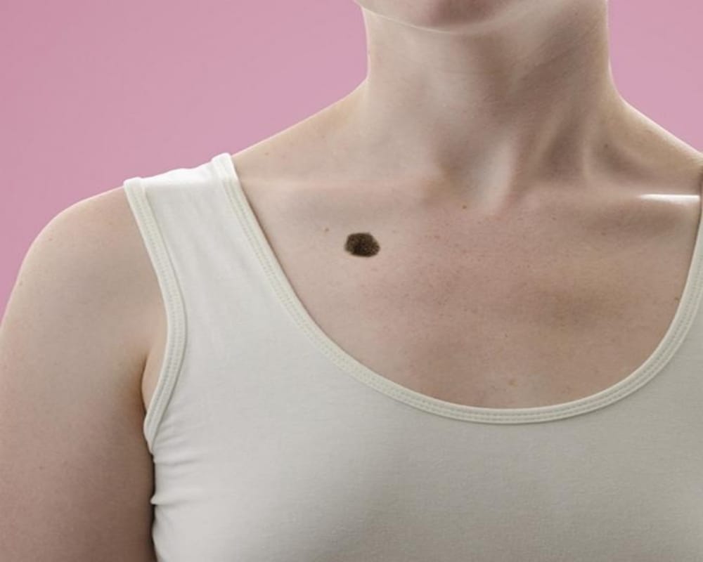 Know how Moles on body that reveal about your relationship