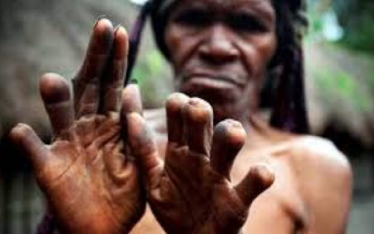 Woman's Finger cut rituals in papua guinea