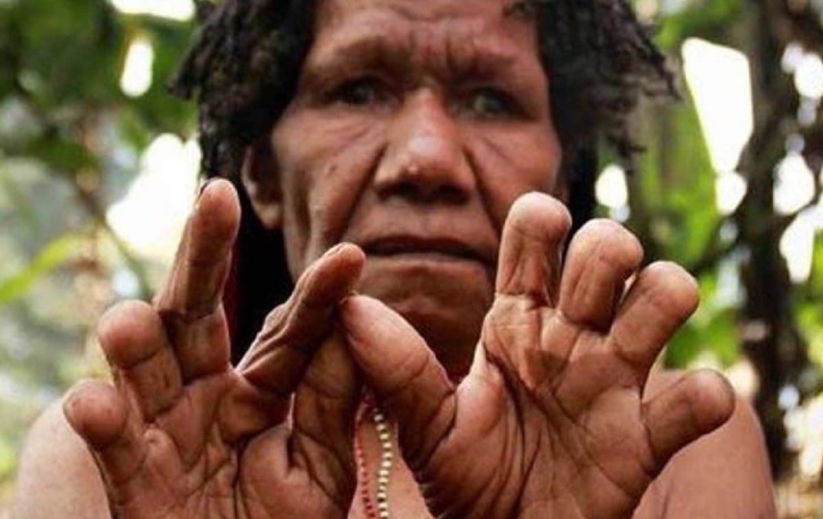 Woman's Finger cut rituals in papua guinea