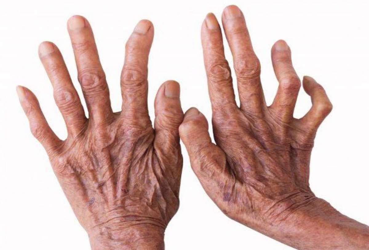 India should ensure financial security for leprosy patients: WHO