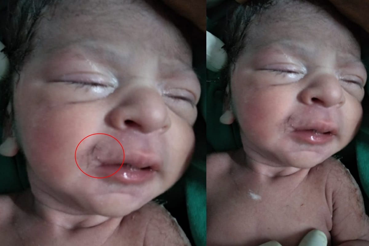UP: baby born with mustache in the meerut hospital doctors also surprised
