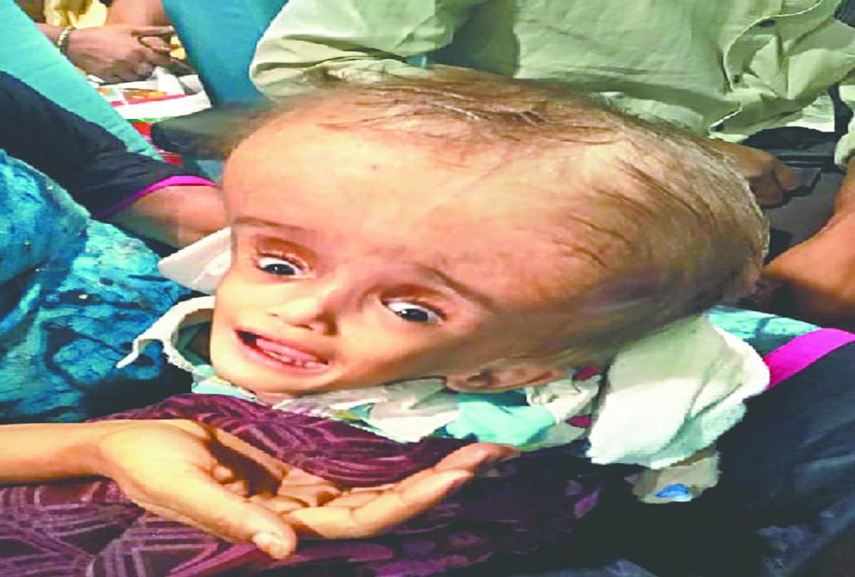 more patients of Spina bifida in India, one or two children of a thousand are suffering form disease