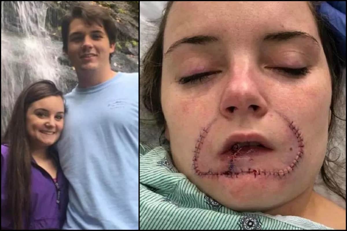 Girlfriend lip bitten off by her ex boyfriend with a strange reason