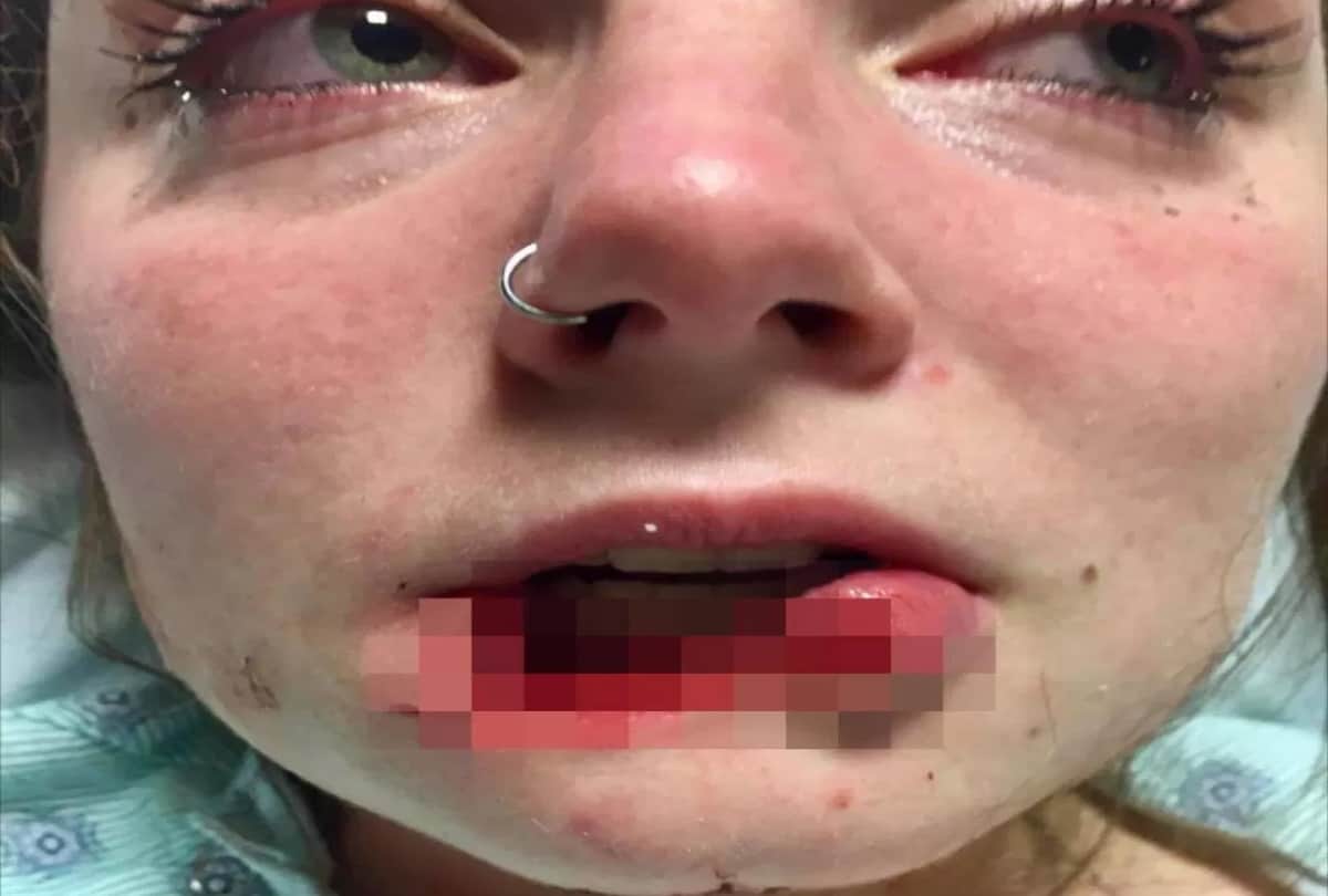 Girlfriend lip bitten off by her ex boyfriend with a strange reason