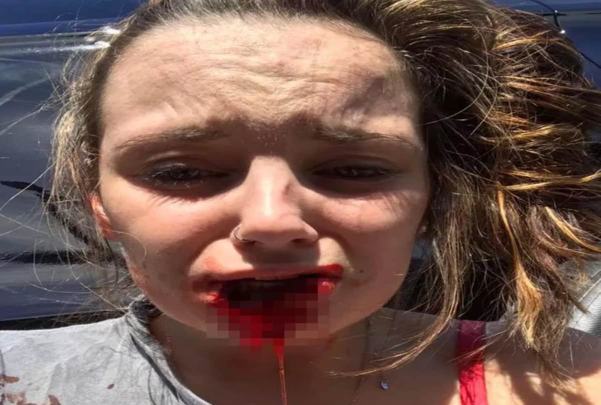 Girlfriend lip bitten off by her ex boyfriend with a strange reason