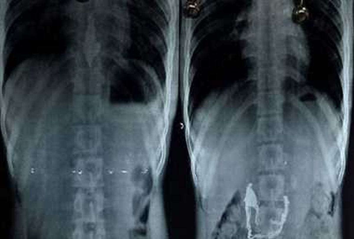 The labourer swallows the gold chain, out of defecation