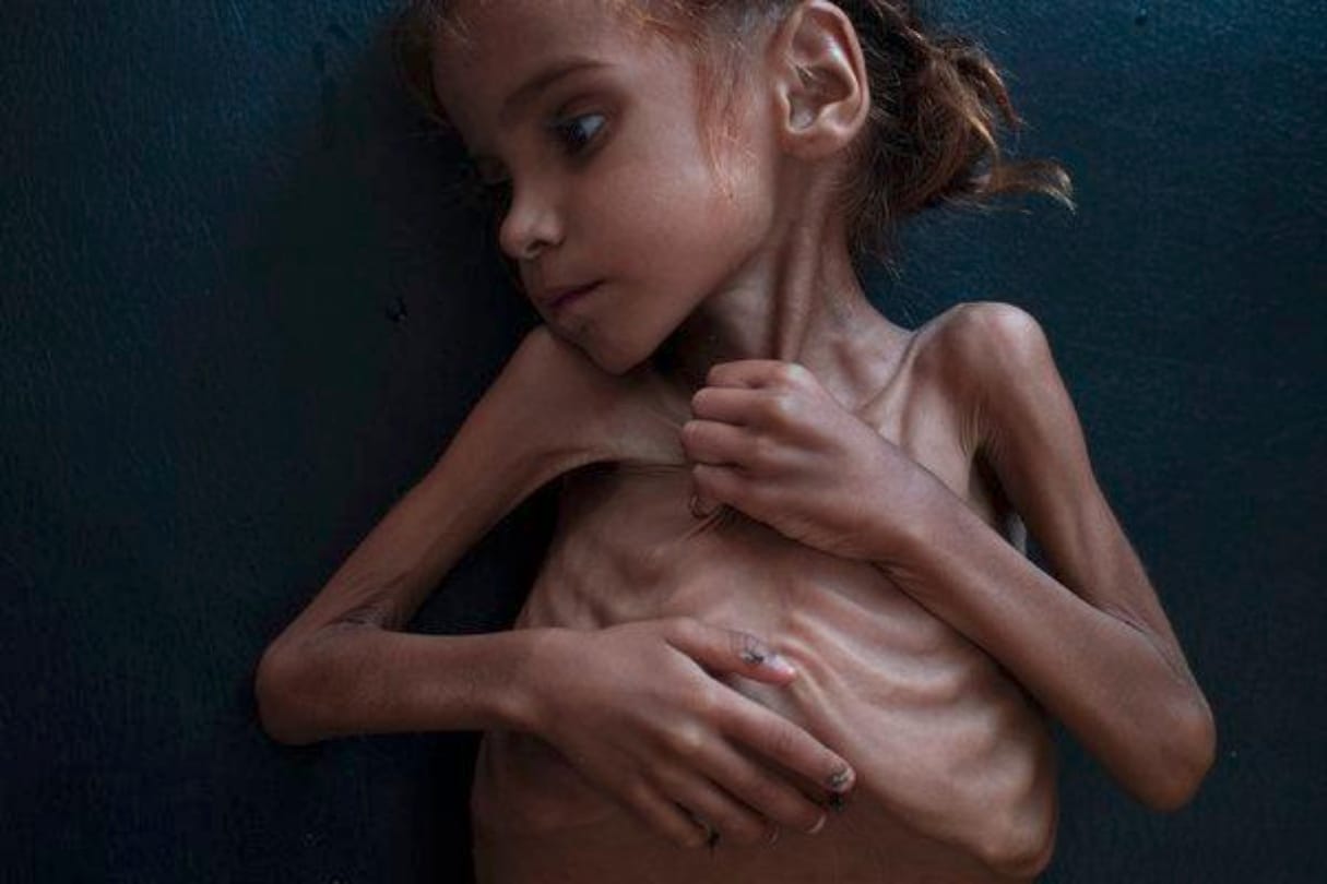 Starvation in Yemen: 7 year old died, lives of 20 lakh women in danger