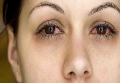 Risk of Allergy in Eyes