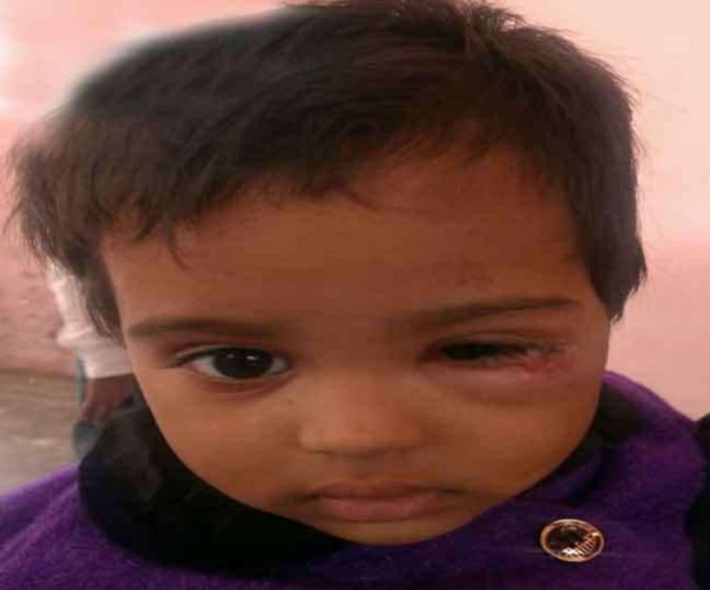 husband beat wife for dowry and burn child eye from Beedi