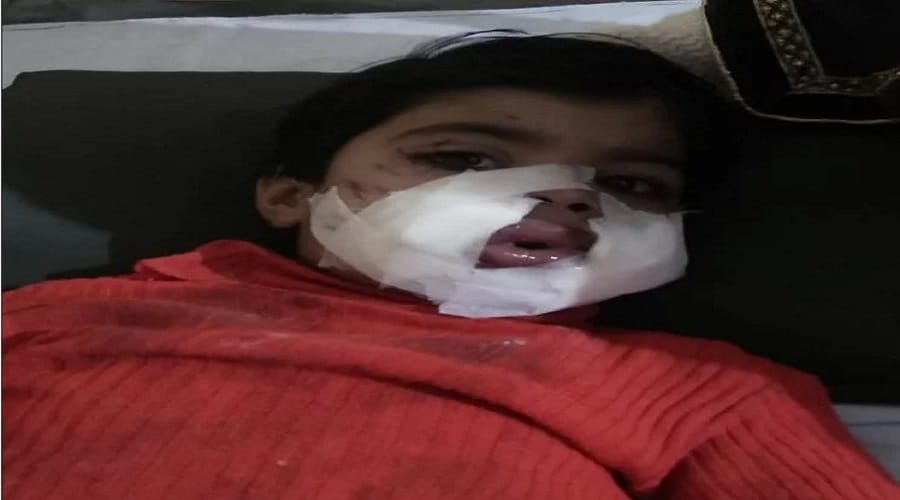 Meerut, bomb fire on three years old girl mouth on diwali and accussed arrested