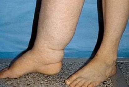 Health Ministry campaign to combat lymphatic filariasis in eight states