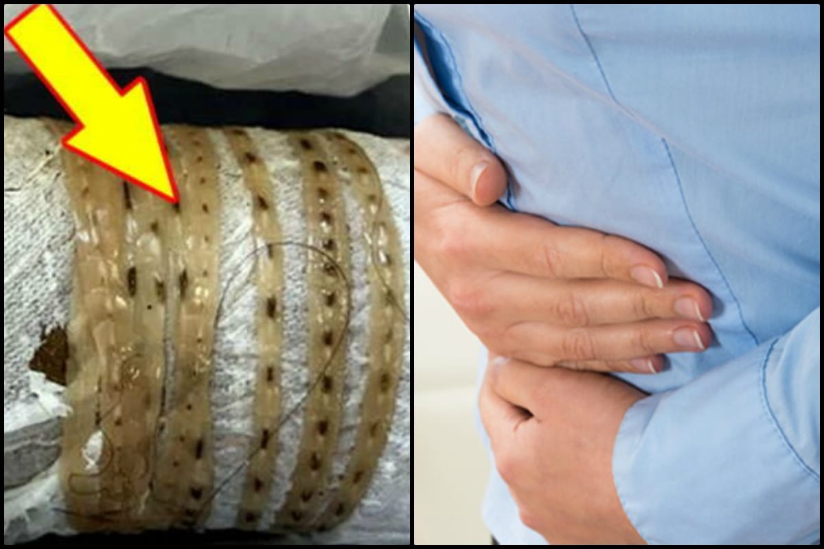 5.5 Foot Long tapeworm Come out from human stomach