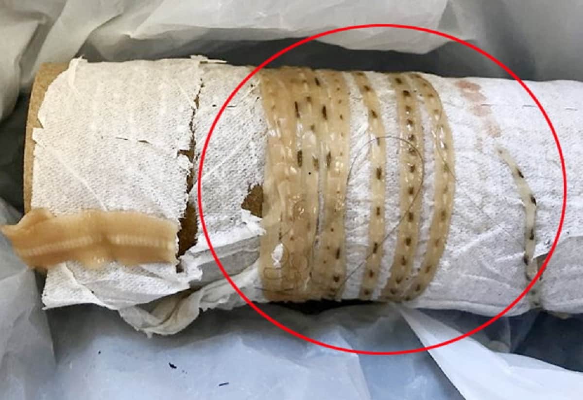 5.5 Foot Long tapeworm Come out from human stomach