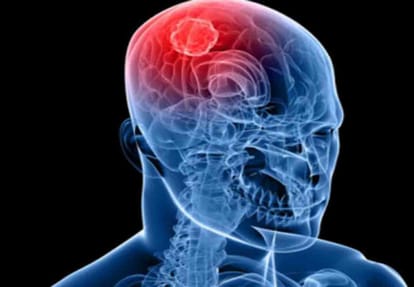 Rapidly growing nasal tumors in people living near the Ganges