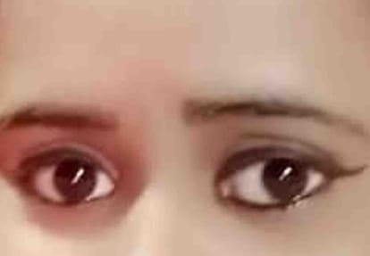 High Blood Sugar is Dangerous for Eyes