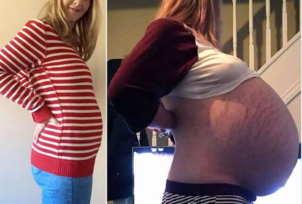 Pregnant Woman Had Strange 25 Kg Cyst Doctors Found In Ultrasound Cyst Pregnancy Test