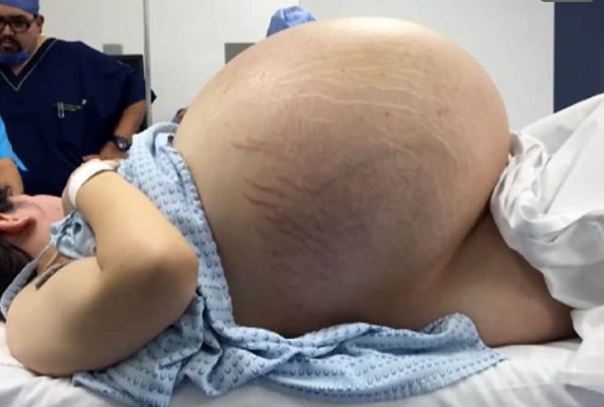 Pregnant Woman Had Strange 25 Kg Cyst Doctors Found In Ultrasound Cyst Pregnancy Test