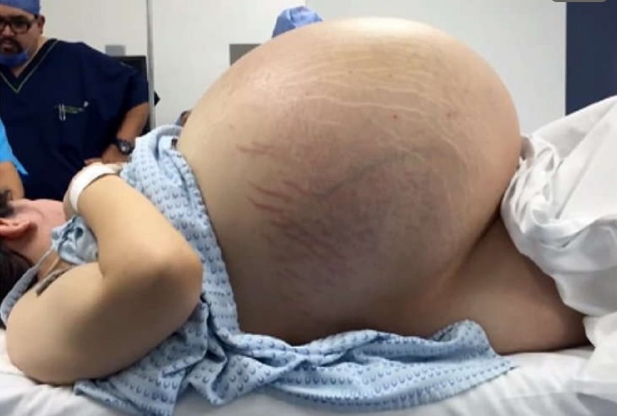 Pregnant Woman Had Strange 25 Kg Cyst Doctors Found In Ultrasound Cyst Pregnancy Test