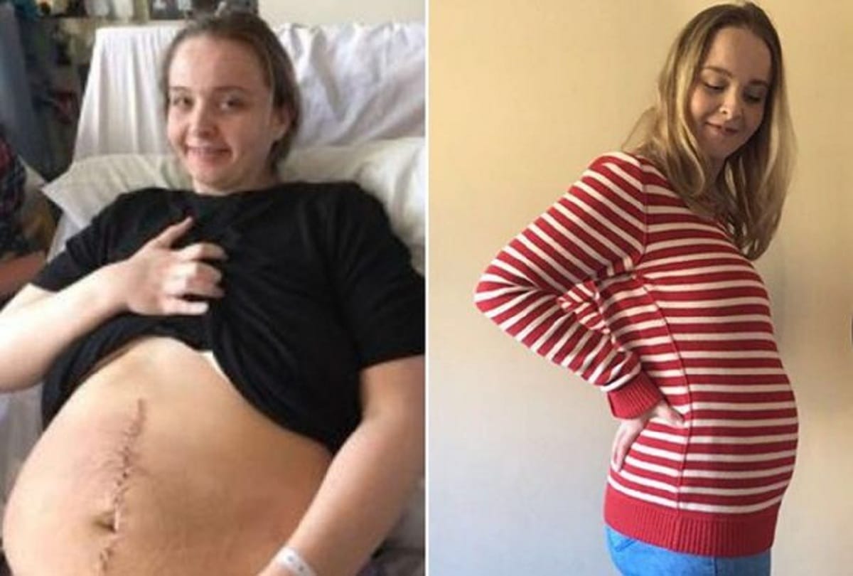 Pregnant Woman Had Strange 25 Kg Cyst Doctors Found In Ultrasound Cyst Pregnancy Test