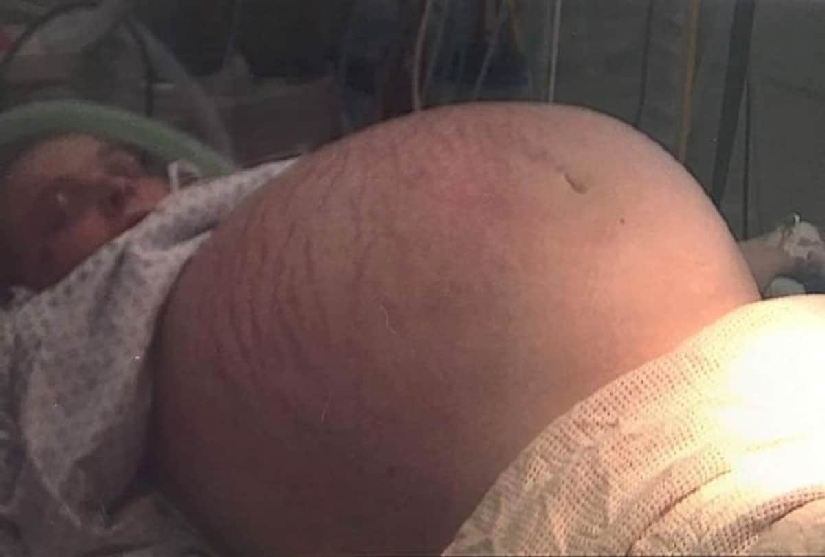 Pregnant Woman Had Strange 25 Kg Cyst Doctors Found In Ultrasound Cyst Pregnancy Test