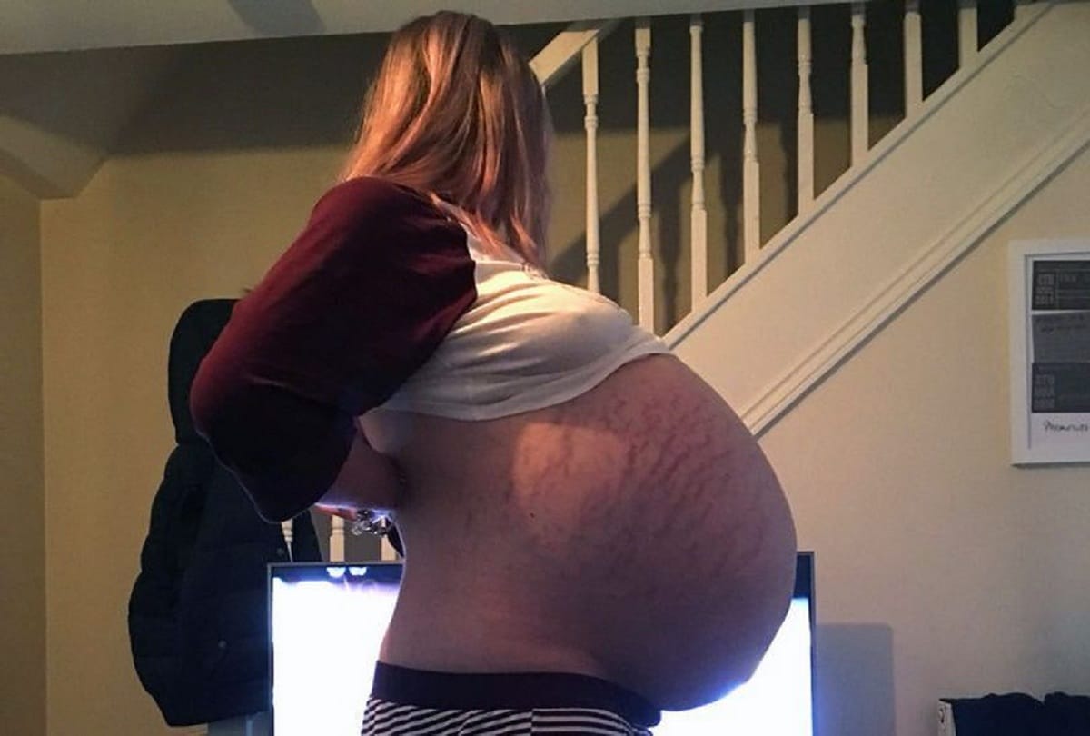 Pregnant Woman Had Strange 25 Kg Cyst Doctors Found In Ultrasound Cyst Pregnancy Test