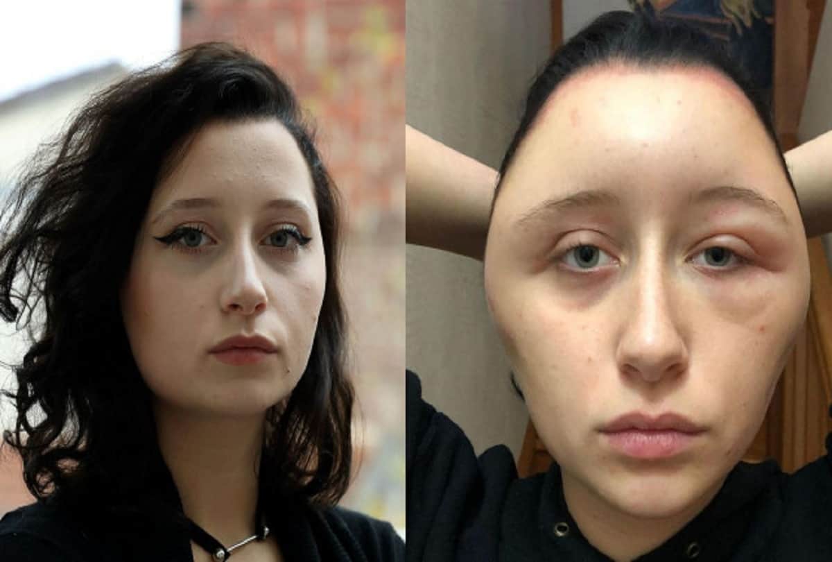 Strange News Hair Dye Colors Allergy Side Effects To Woman Weird Images