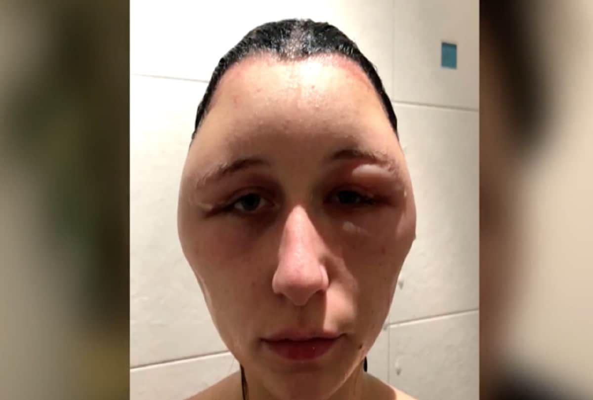 Strange News Hair Dye Colors Allergy Side Effects To Woman Weird Images