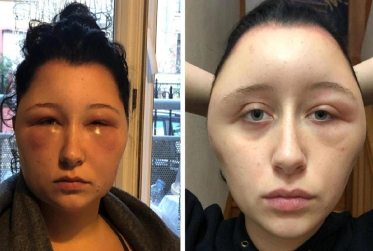 Strange News Hair Dye Colors Allergy Side Effects To Woman Weird Images