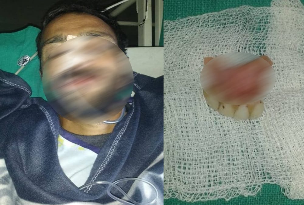 Teeth Found in stomach During patient operation in Doon Hospotal