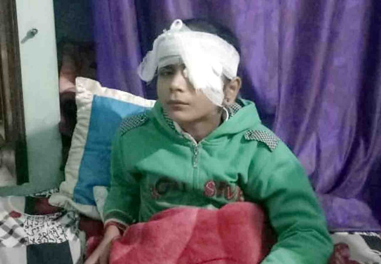 teacher thrown stick over girl and her eye damaged