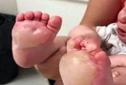 suddenly the childs feet blisters began doctor told shocking truth to his mother
