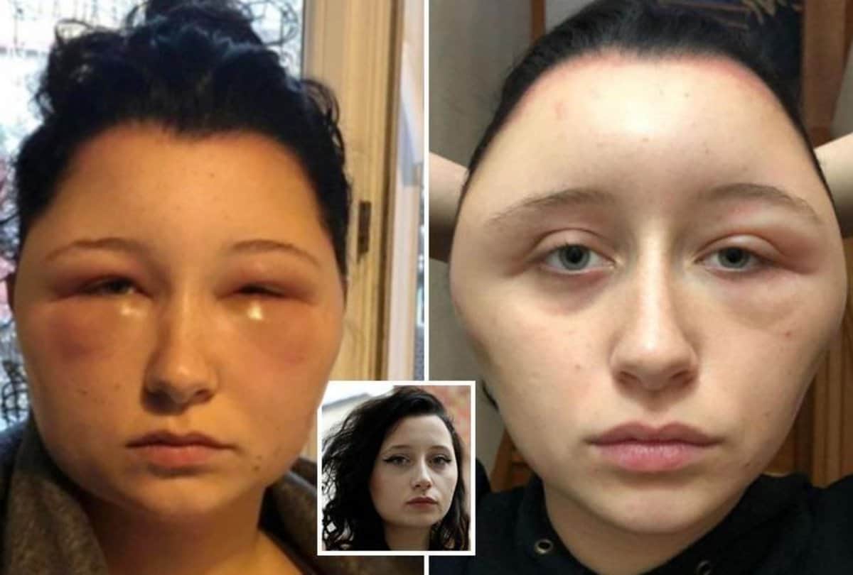 viral story france girl do hair dye which result allergic to her and head size becomes double
