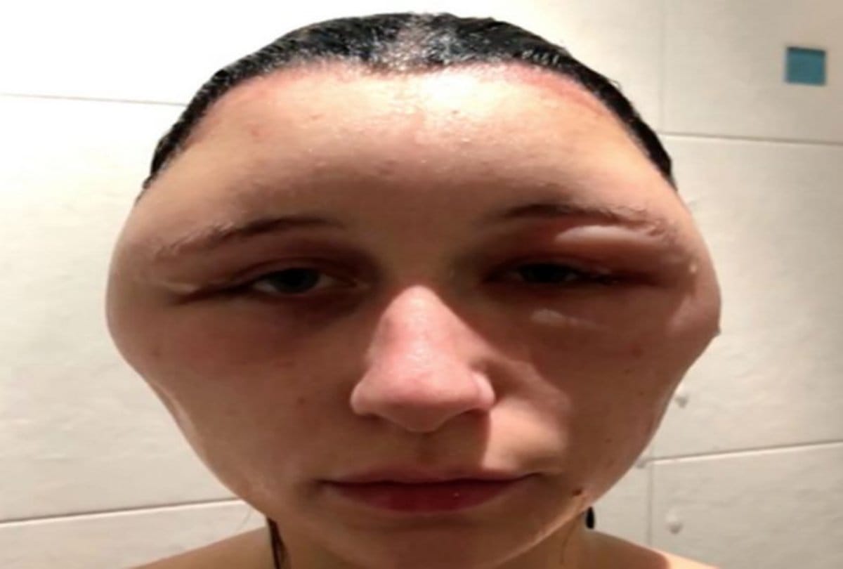 viral story france girl do hair dye which result allergic to her and head size becomes double